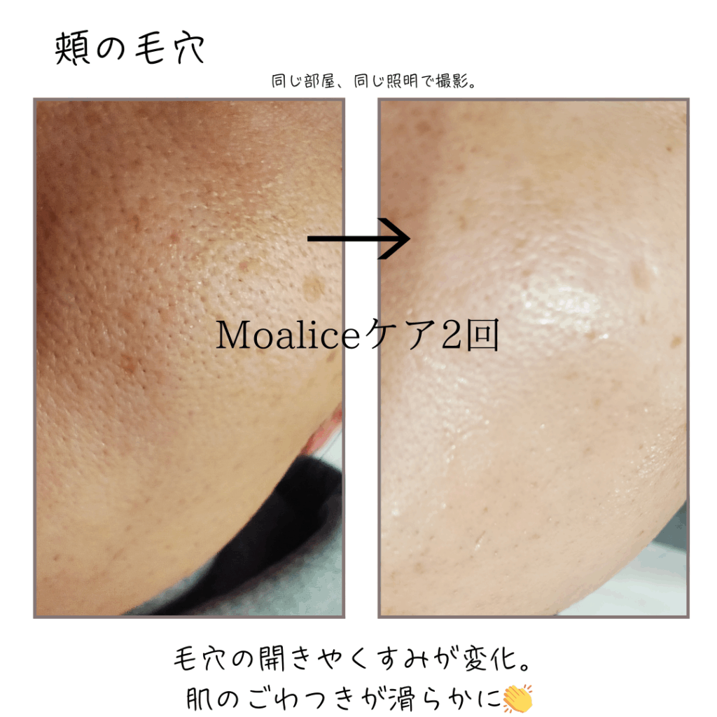 頬の毛穴開き悩みにスピキュールケア（モアリストリートメント）をした比較写真